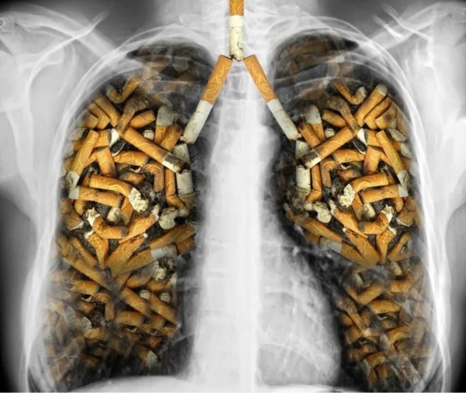 Rokok dan Risiko Kanker Paru: Mitos atau Fakta?