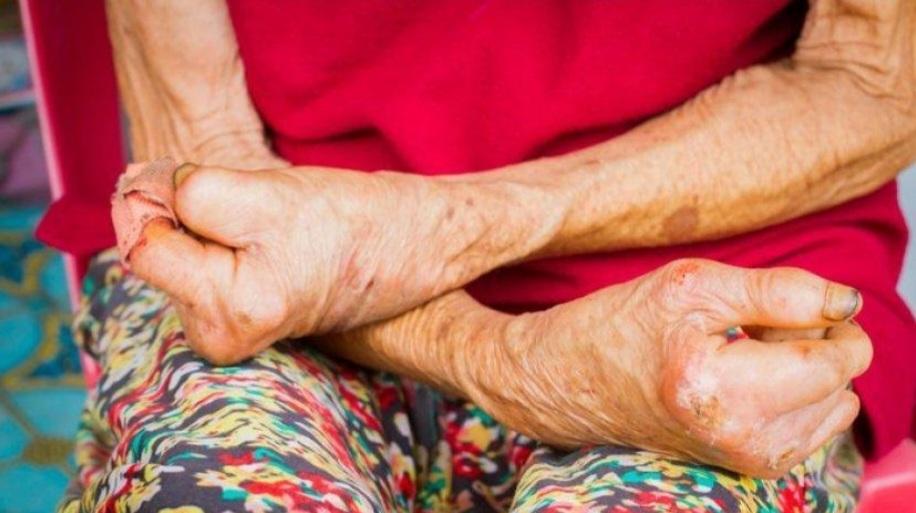 STIGMA DAN DISKRIMINASI MENJADI PENGHAMBAT SEMBUHNYA KUSTA