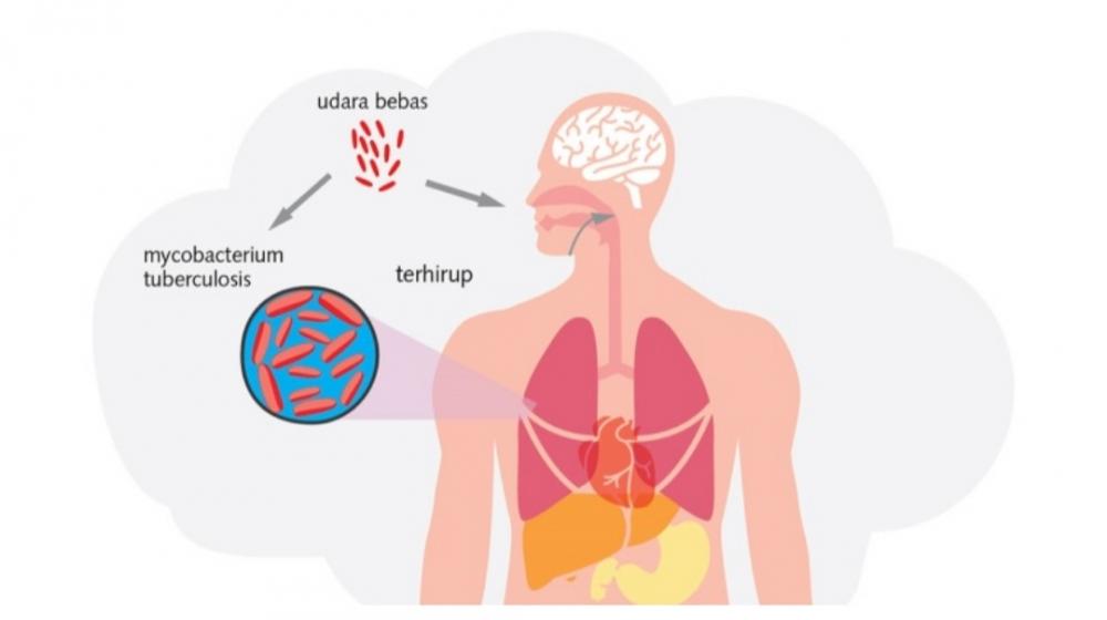 Tuberculosis Mulai Aktif Ya Bund